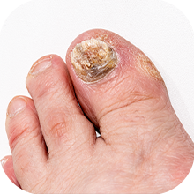 8_Onychomycosis Fungal Nails.png