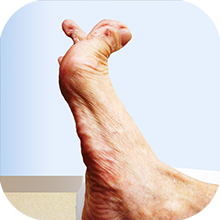 14 Care of Foot Deformity_sml